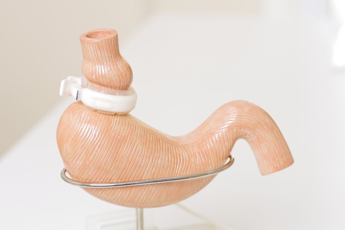 Gastric Band in Turkey Cayra Clinic