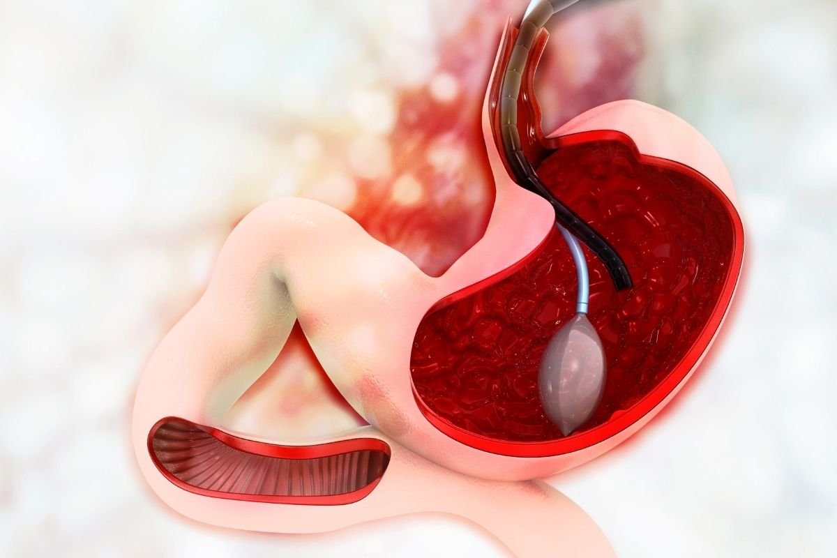 Gastric Sleeve in Turkey Cayra Clinic