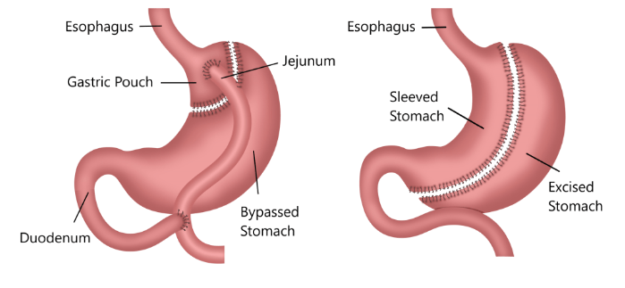 Gastric Sleeve vs. Gastric Balloon
