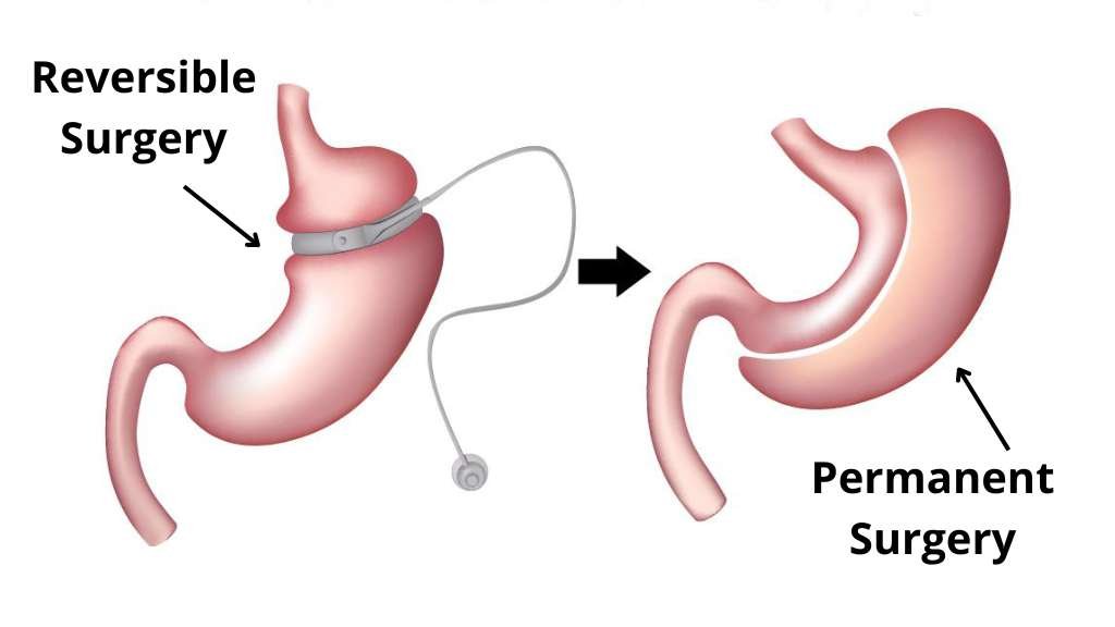 Gastric Sleeve Reversible